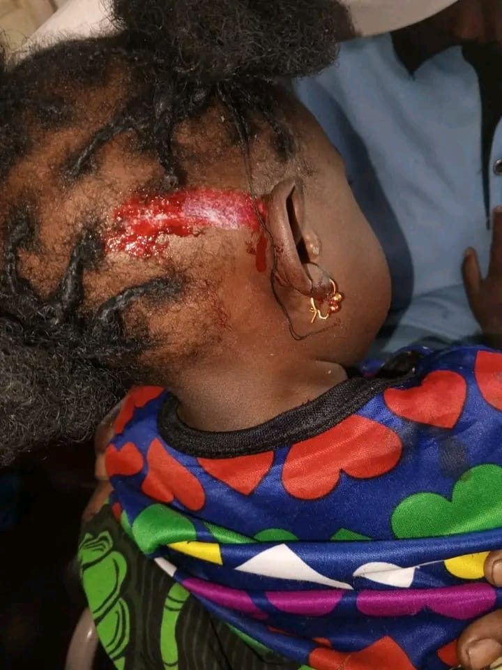 MENOR DE 3 ANOS ATACADA POR MACACO EM MECULA